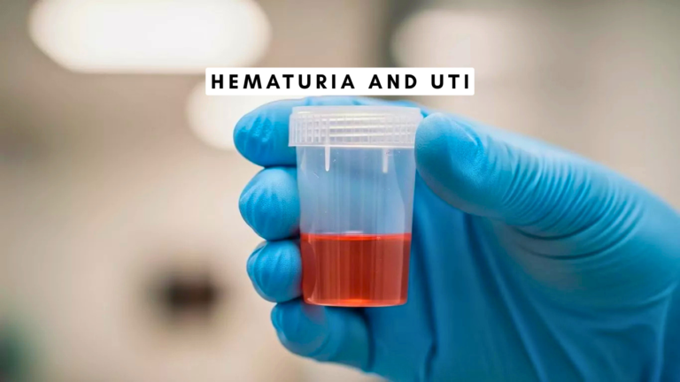 Hematuria and UTI Causes Symptoms Treatment and Prevention beccles museum
